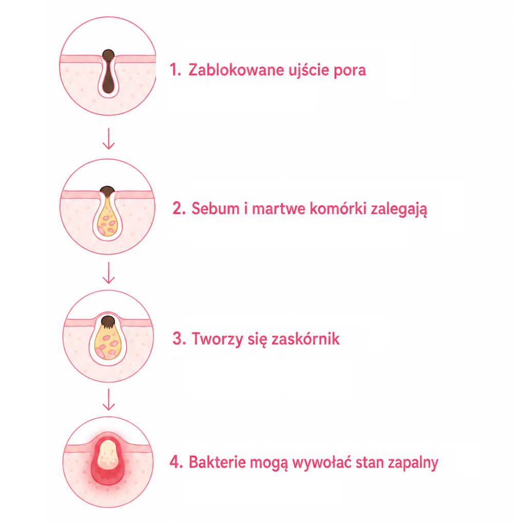 od czego zapychaja sie pory
